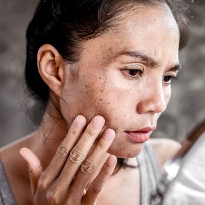 Asian woman having skin problem checking her face with dark spot, freckle from UV light in mirror